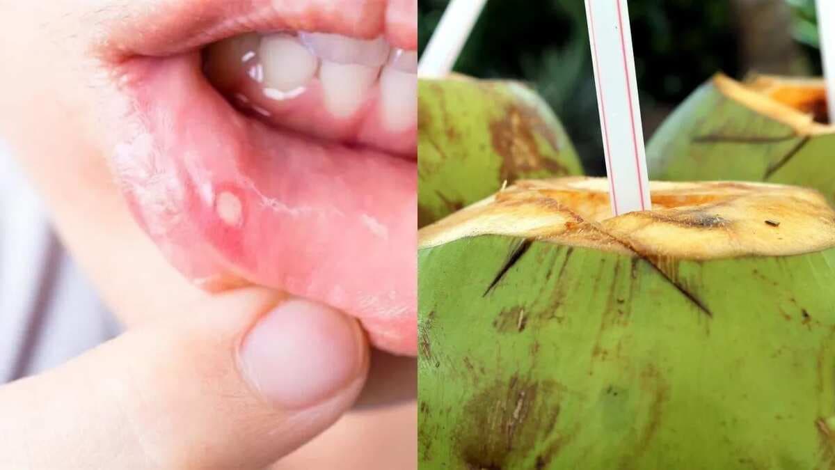 Drink Coconut Water And Bid Adieu to Mouth Ulcers 