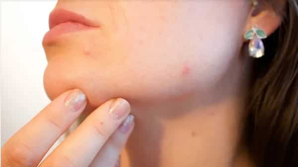 3 Quick And Easy Home Remedies For Acne 