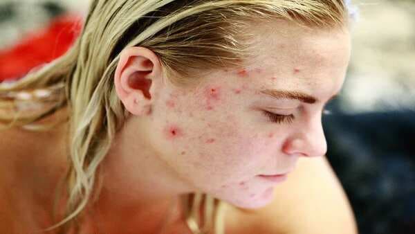 Is Your Skin Prone To Acne? Know If Your Diet Has A Part to Play In It